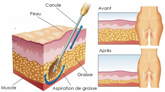 lipocussion1