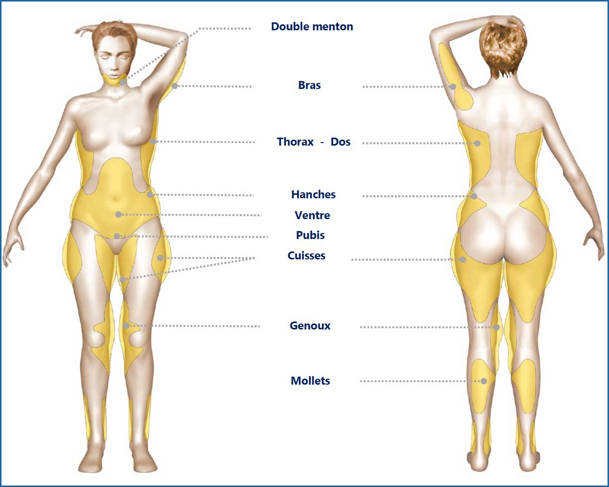 zones-liposuccion-corps